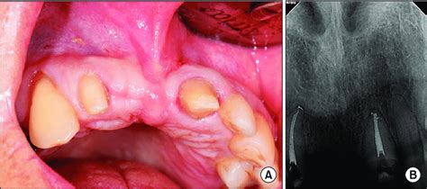 Initial Intraoral Photograph And Radiograph Of Case Patient A Good