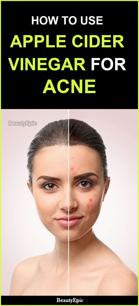 How To Use Apple Cider Vinegar For Acne Treatment Vinegar For Acne