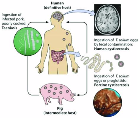 A Rare Case Of Human Taeniasis Caused By Taenia Saginata 47 OFF