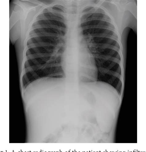 Figure From Hemophagocytic Syndrome Associated With Mycoplasma