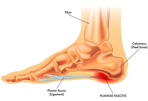 Plantar Fasciitis - Heel Pain - Qld Orthotics