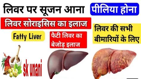 Fatty Liver Ka Unani Liver Sirosis Ka Ayurvedic Ilaj Hepatitis Ka