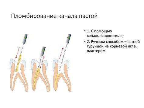 Методы обтурации корневых каналов. Ошибки и осложнения при обтурации ...