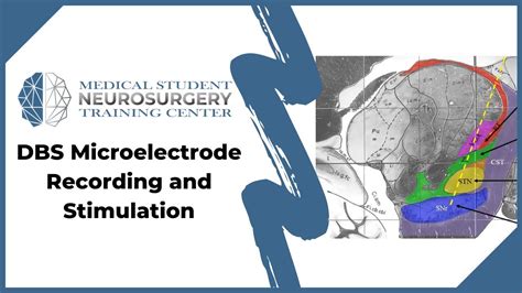 Dbs Microelectrode Recording And Stimulation Youtube