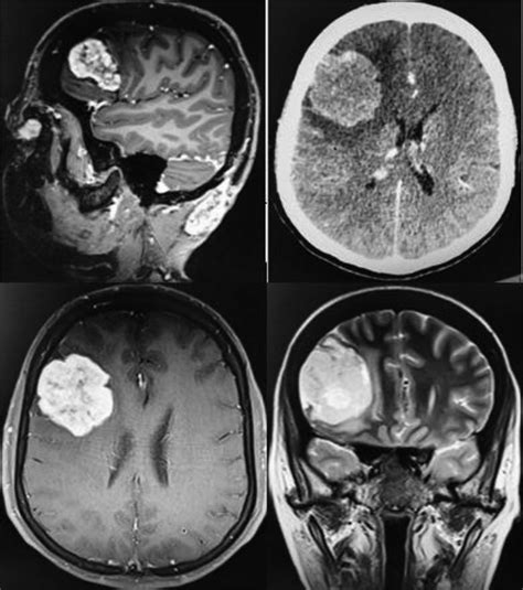 Preoperative Radiological Imaging Ct And Mri Showing A Download Scientific Diagram