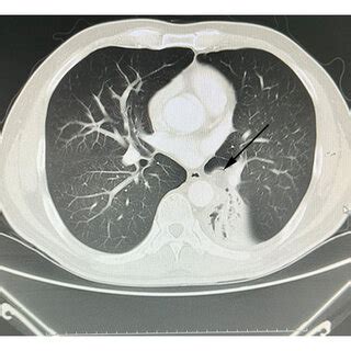 The Findings Of The Endobronchial Lipoma On Chest Ct Showing A Low