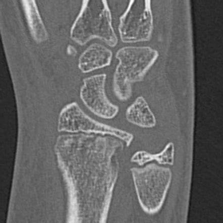 Ct Apperance Of Ulnar Impingement Syndrome Secondary To Negative Ulna