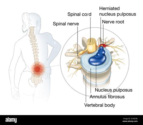 Illustration Showing Lumbal Vertebra With Intervertebral Disc And