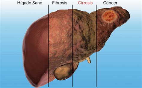 Cirrosis Hepatica Dr Maximiliano Garcia Especialista En Medicina