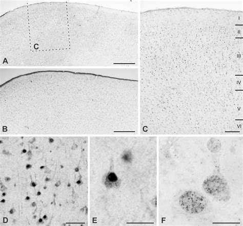 UBE3A Expression In Temporal Cortex From A Human Biopsy Specimen A