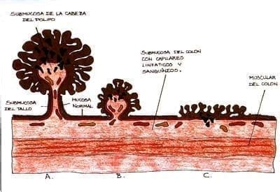 Pólipo Pediculado É Perigoso - RESECCIÓN DE PÓLIPOS PEDICULADOS Y SEUDOPEDICULADOS, MEDICINA