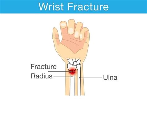 distal radius fractures treatment singapore sbf