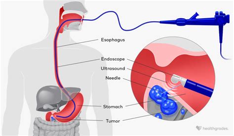 Endoscopic Ultrasound Procedure Risks And Preparation