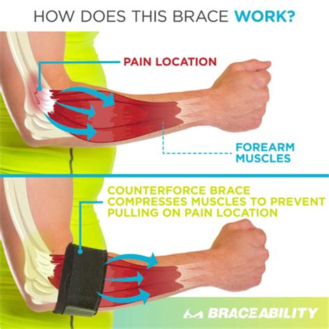 Management Of Common Elbow And Forearm Conditions Flashcards Quizlet