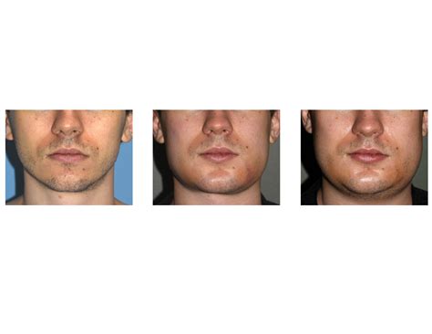 Swelling and Recovery after Custom Jawline Implant Surgery - Explore