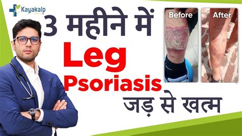 3 महीने में सोरायसिस जड़ से खत्म How To Treat Leg Psoriasis Leg