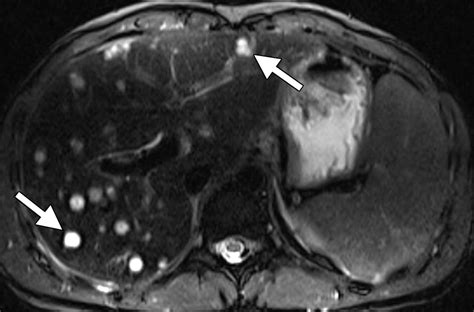 Hematologic Malignancies Of The Liver Spectrum Of Disease Radiographics