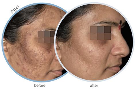 Cosmelan Md Peel Skinaesthetica