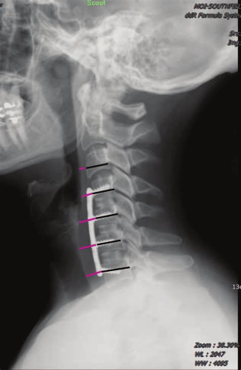 Demonstration Of Radiographic Measuring Technique To Determine