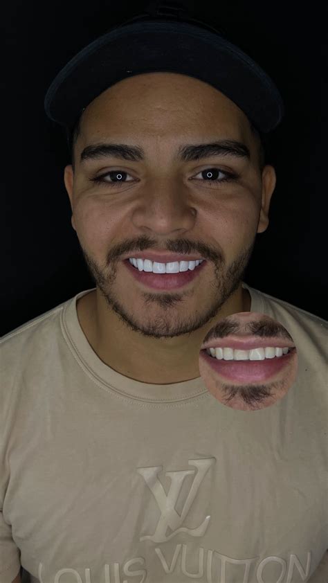 FACETAS EM RESINA | Transformação em FACETAS DE RESINA PREMIUM | Instagram