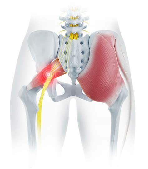 Piriformis Syndrome Nbkomputer