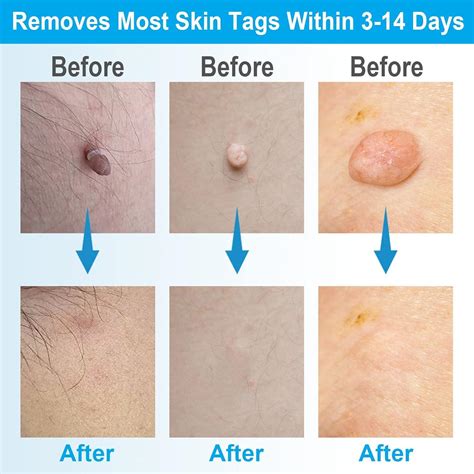 Painless 2-in-1 Skin Tag Removal Kit for Micro to Large Skin Tags (1