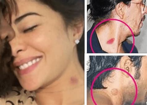 Celebs With Hickeys
