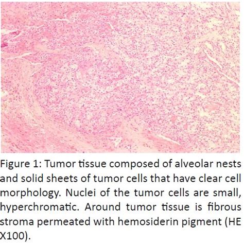 Tumor Tissue Composed Of Alveolar Nests And Solid Sheets Of Tumor Cells