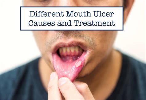 Different Mouth Ulcer Causes And Treatment