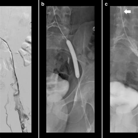 Left Common Iliac Vein Thrombus Demonstrated On Catheter Venogram A