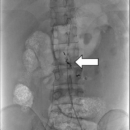 Intraoperative finding of psoas muscle injury. | Download Scientific ...