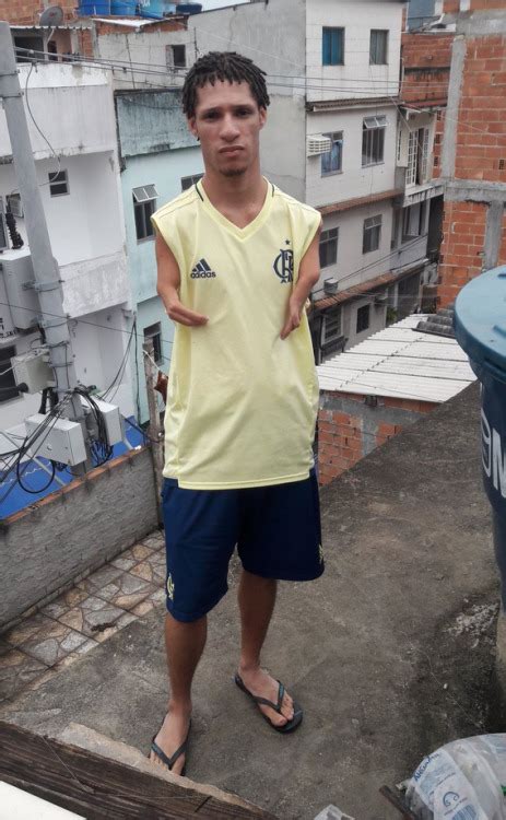 Gay Amputee Tumblr Tumbex