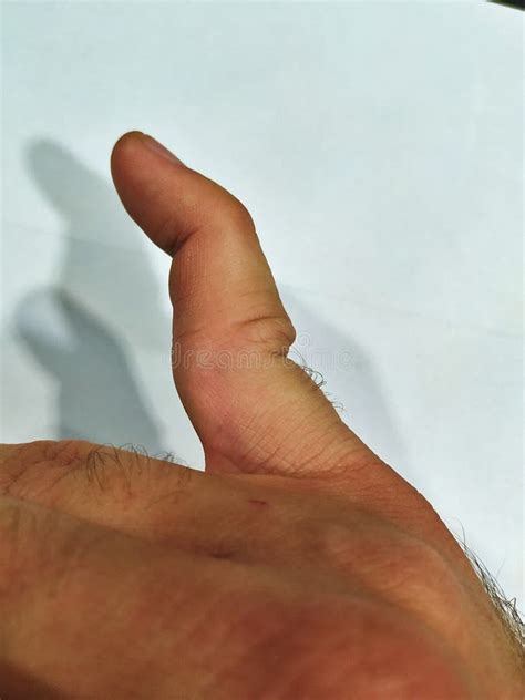 Dislocated Little Finger Joint Before Treatment And Healing Stock Image