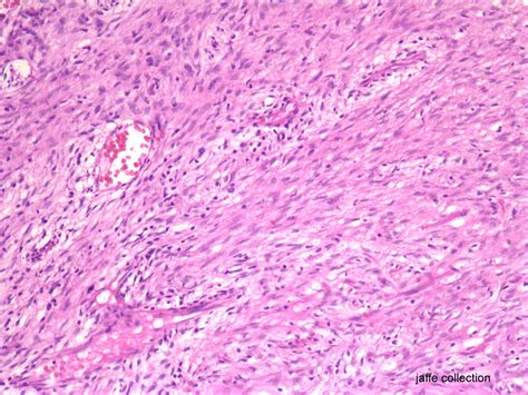 Enchondroma Vs Chondrosarcoma Roboflow Universe