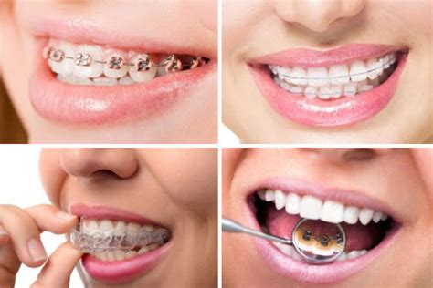 Qu Elegir Brackets Alineadores Transparentes U Ortodoncia Lingual