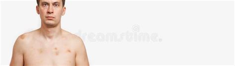 Brunette Man With Bruises On Body Standing With Naked Torso And Looking Forward With Pain After