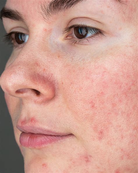 Rosacea Treatment In Singapore A Guide To Managing Skin Redness The