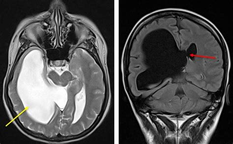 Fenestration For Unilateral Hydrocephalus Radiology Cases