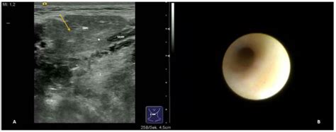 Jcm Free Full Text Ultrasound And Sialendoscopy Findings In