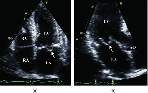 Discrete Subaortic Stenosis Thoracic Key