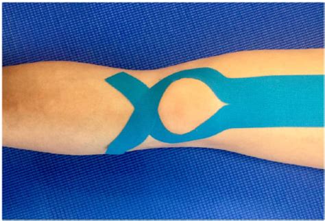 Kinesio Taping For PFPS Patellofemoral Pain Syndrome 51 OFF