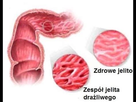 Zespół jelita drażliwego 4 porady by złagodzić objawy YouTube