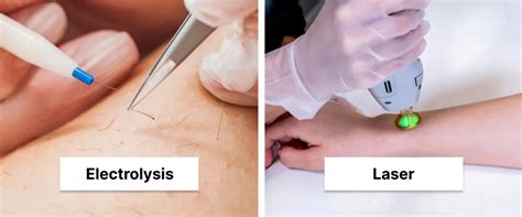 Laser Hair Removal vs Electrolysis: Which Is Better For You? - PZLASER
