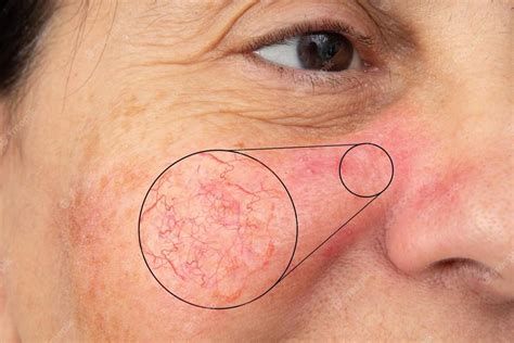 Rosacea On Cheeks