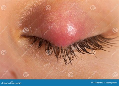 Hordeolum On Upper Eyelid Viral Infection Stock Image Image Of