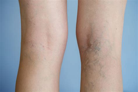 Sclerotherapy Near Me Varicose Veins Treatment Boston Evolution Med