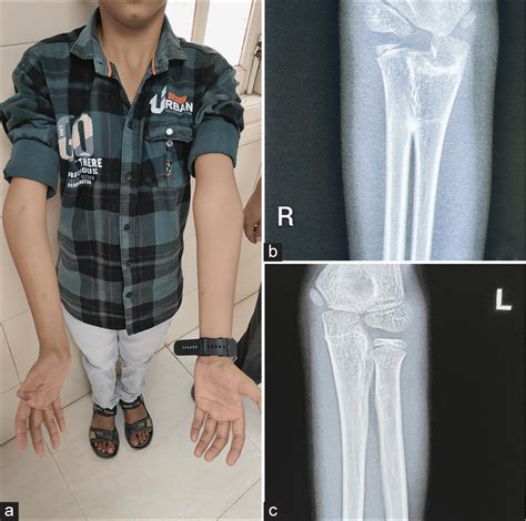 Imaging In Congenital Proximal Radioulnar Synostosis Wadia Journal Of