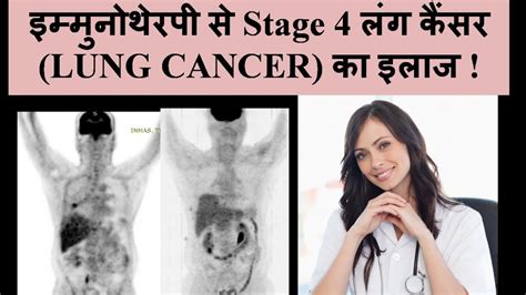 कैंसर इम्मुनोथेरपी से फेफड़े कैंसर Lung Cancer का इलाज Lung Cancer Immunotherapy Hindi 2018