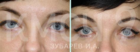 Блефаропластика | Пластика век в Омске | цены, фото до и после