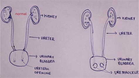 Ureterocele On Ct Cobra Head Sign 🐍 Youtube